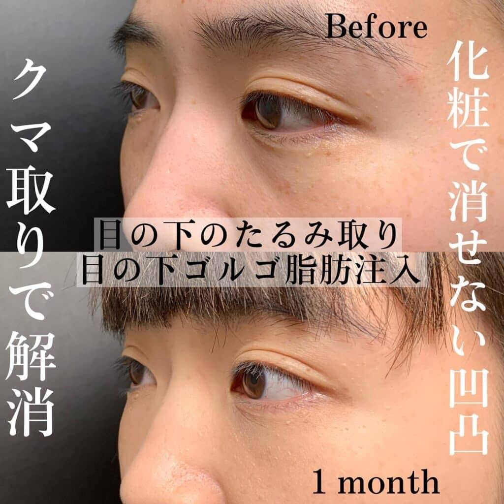 経結膜脱脂＋脂肪注入の症例写真