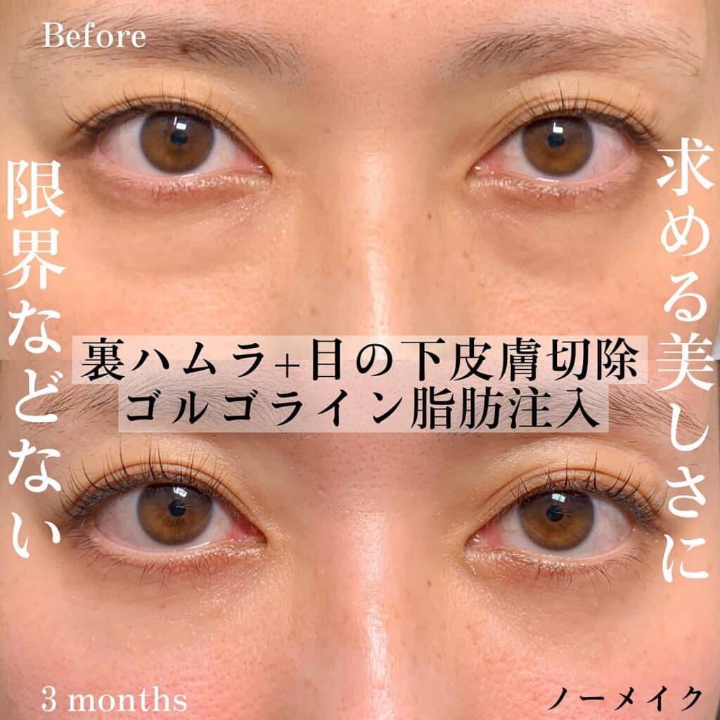 裏ハムラ＋目の下皮膚切除＋ゴルゴライン脂肪注入の症例写真