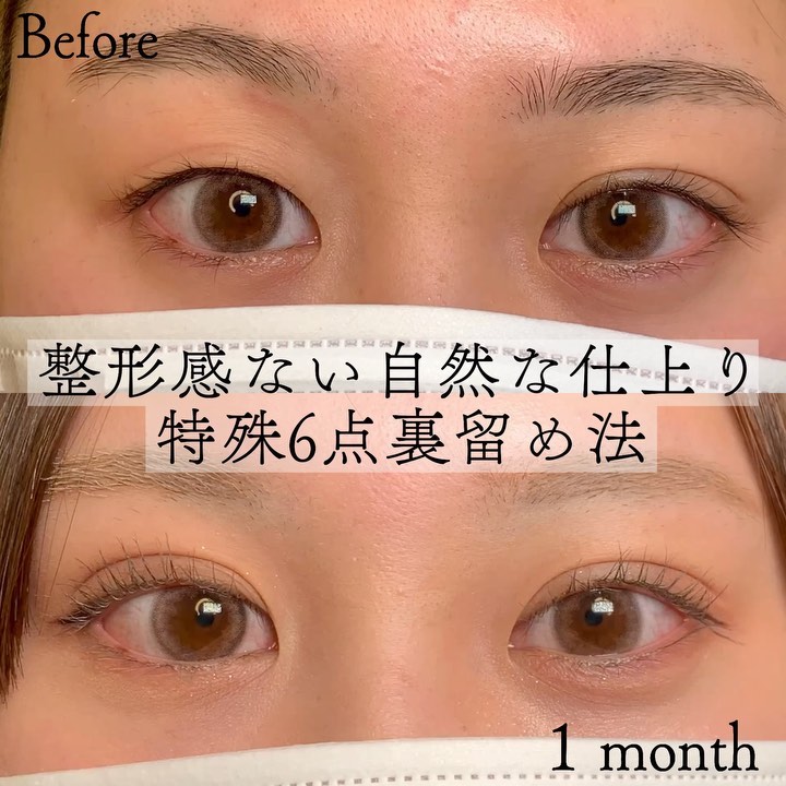 eclinic東京院の埋没法(特殊6点裏留め)