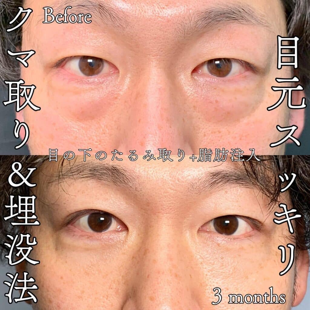 経結膜脱脂＋埋没法の症例写真