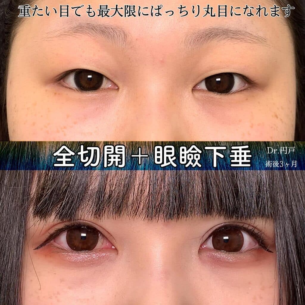 eclinic東京院の全切開二重術＋眼瞼下垂