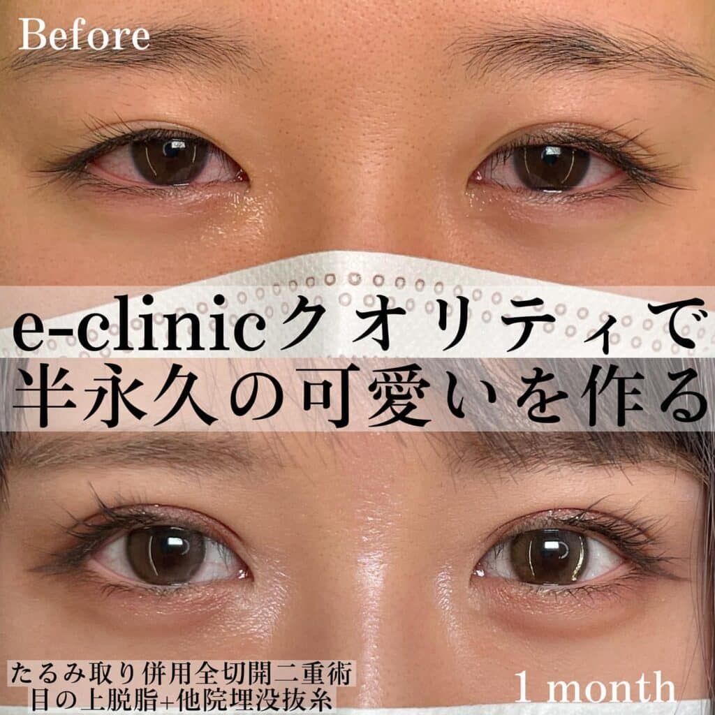 eclinic東京院の全切開+目の上脱脂+他院抜糸