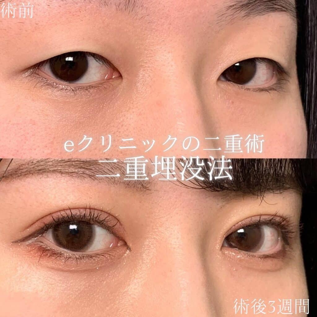 eclinic東京院の埋没法