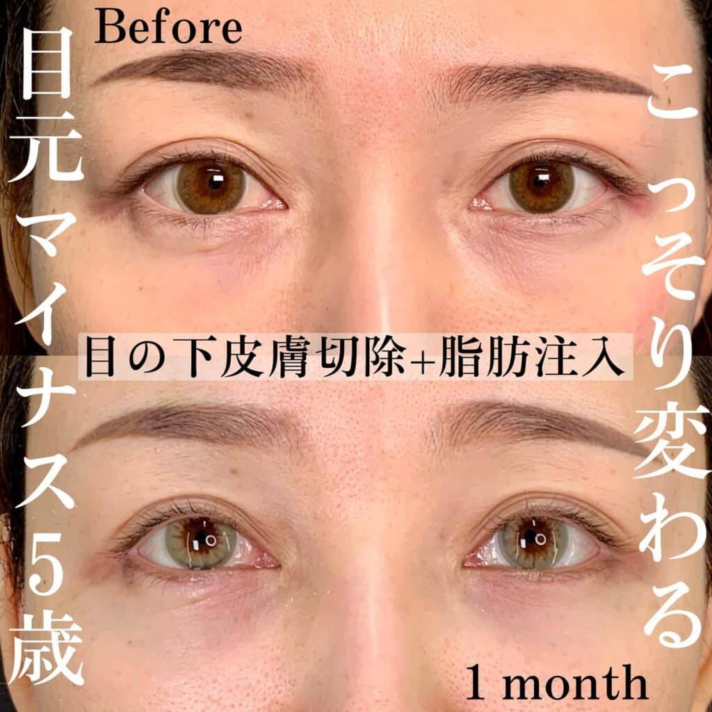 目の下皮膚切除＋脂肪注入
