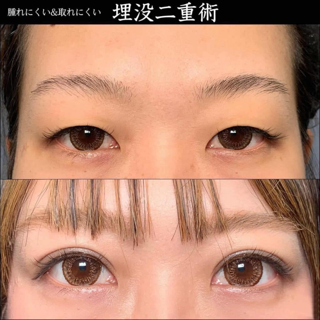 eclinic東京院の二重埋没法