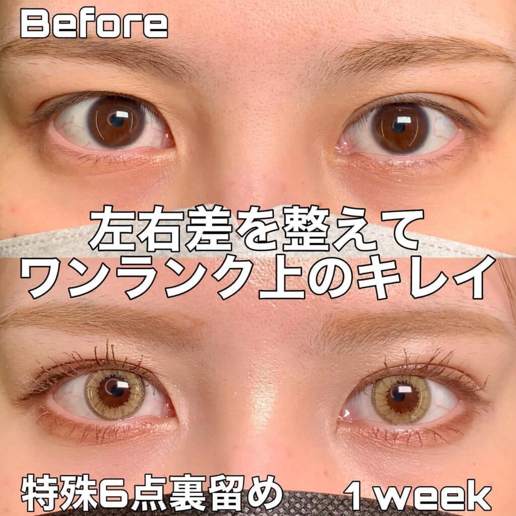 eclinic東京院の埋没法(特殊6点裏留め)