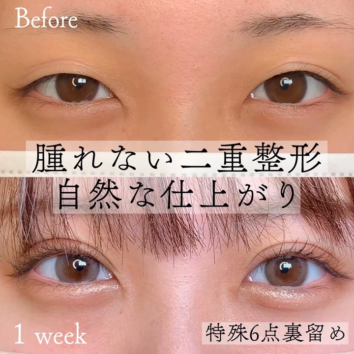 eclinic東京院の埋没法(特殊6点裏留め)
