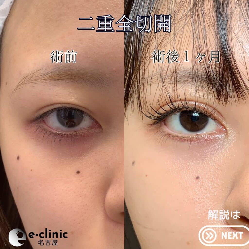 eclinic東京院の全切開二重術