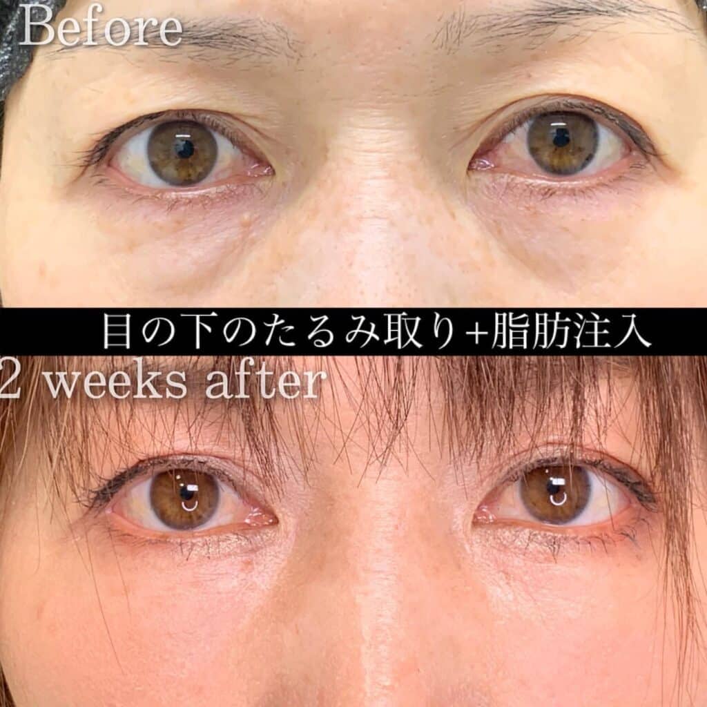 経結膜脱脂＋脂肪注入の症例写真