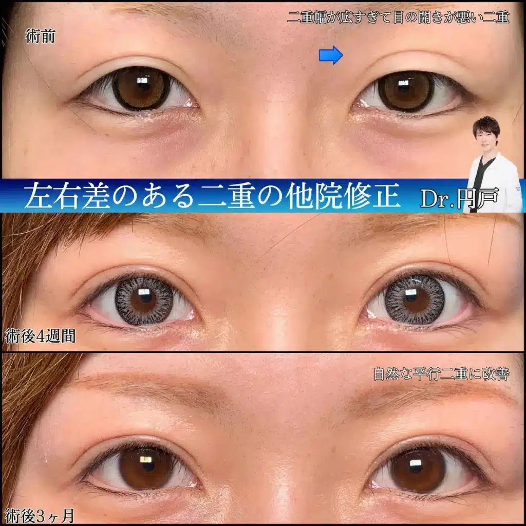 eclinic東京院の二重埋没法の他院修正