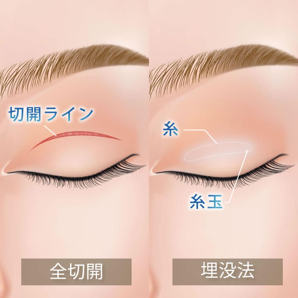 eclinic東京院の埋没法と全切開二重術
