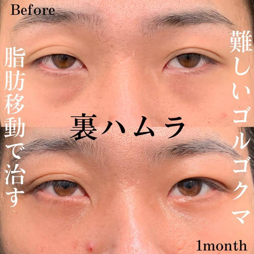 裏ハムラの症例写真