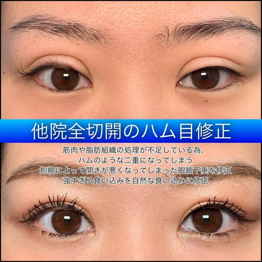 eclinic東京院の全切開二重術の他院修正（ハム目修正）