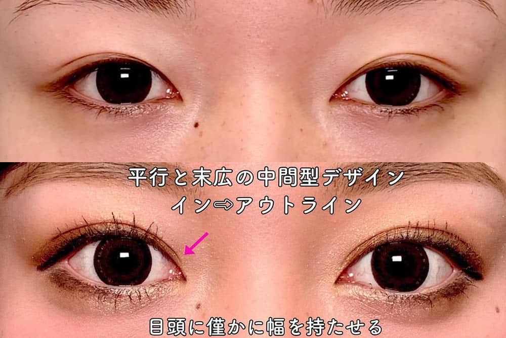 eclinic東京院の二重埋没法