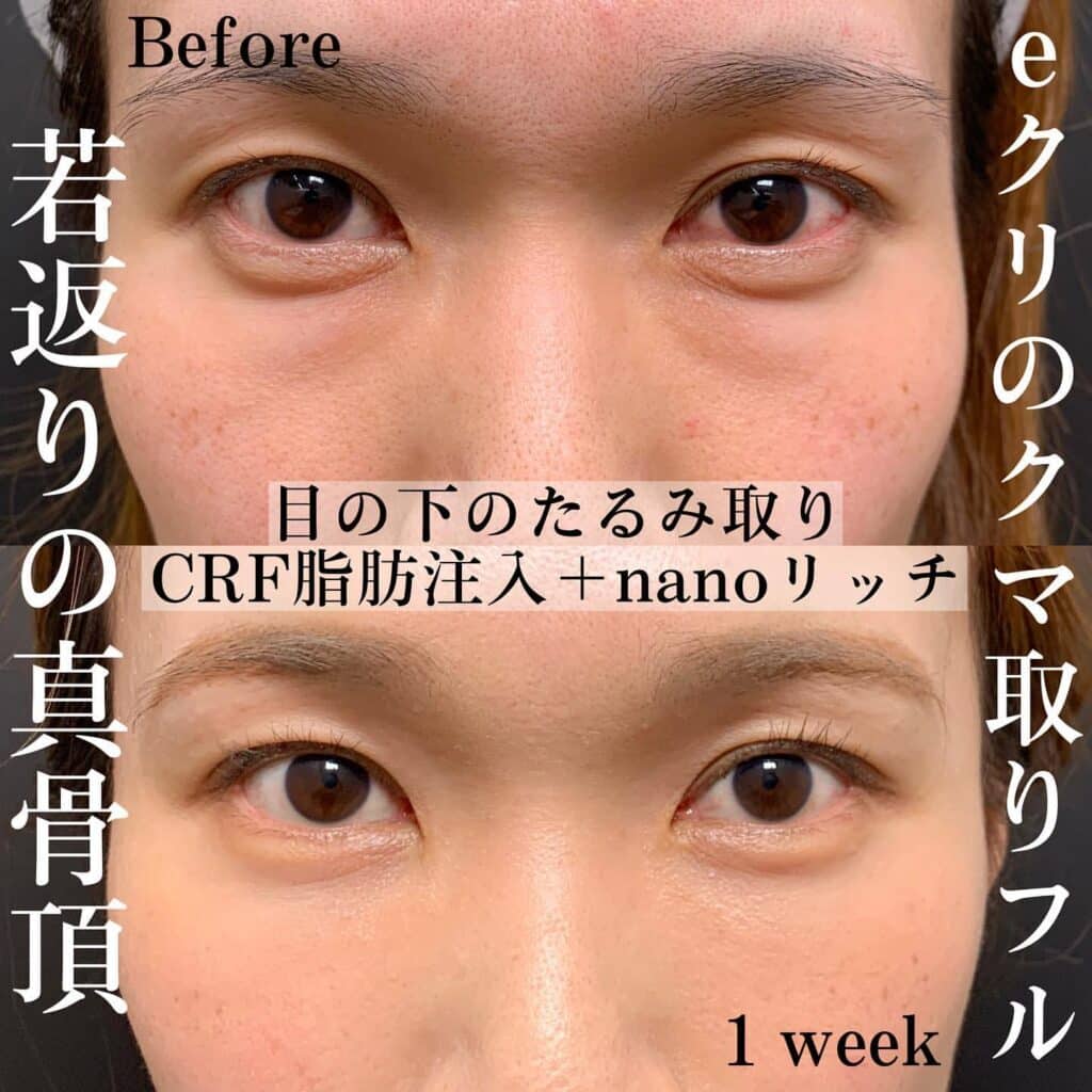経結膜脱脂＋脂肪注入＋ナノリッチ脂肪注入の症例写真