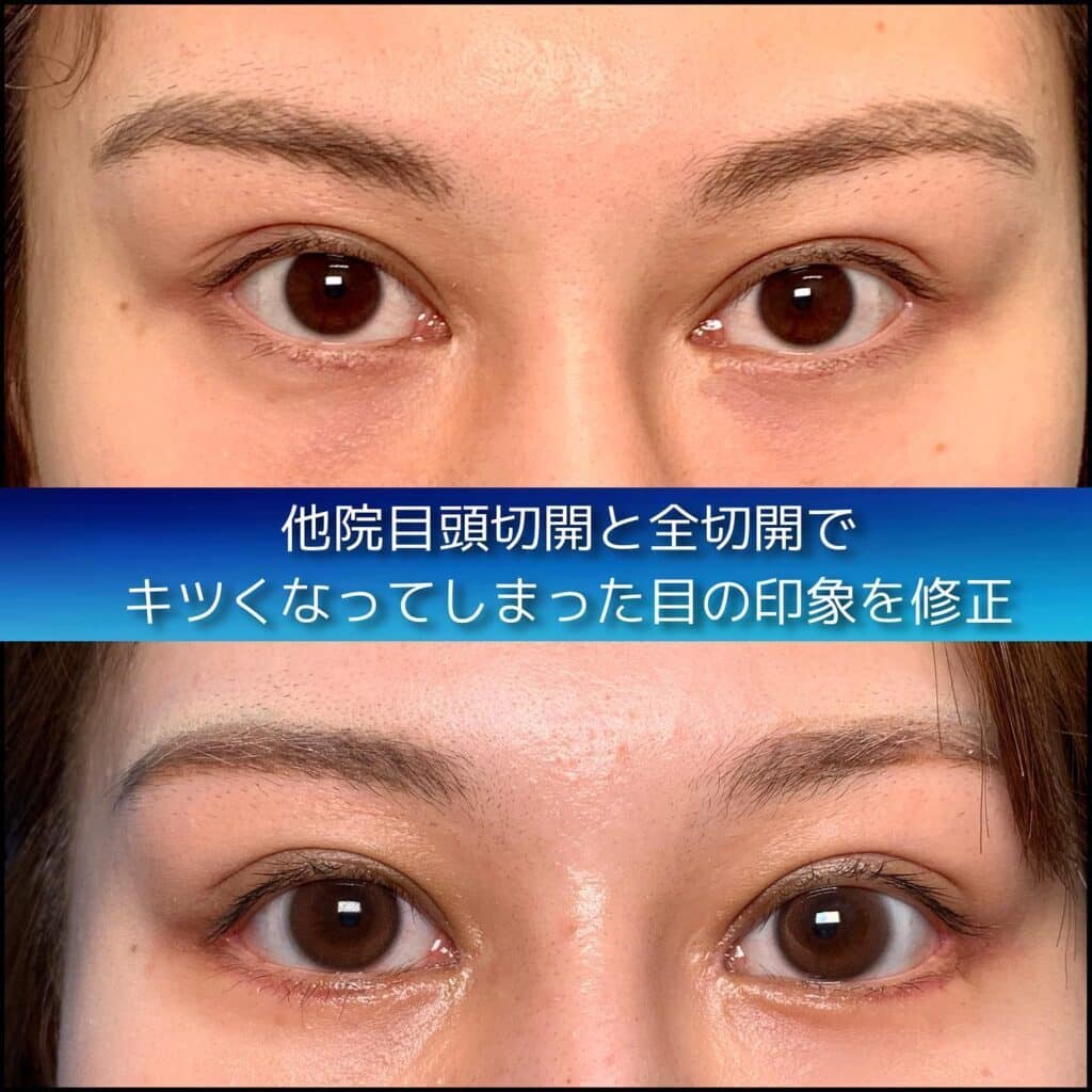 eclinic東京院の全切開二重術＋目頭切開（他院修正）
