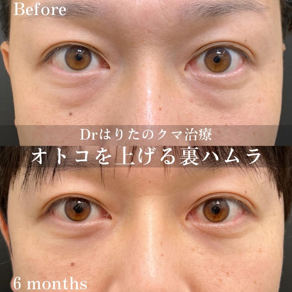 裏ハムラの症例写真