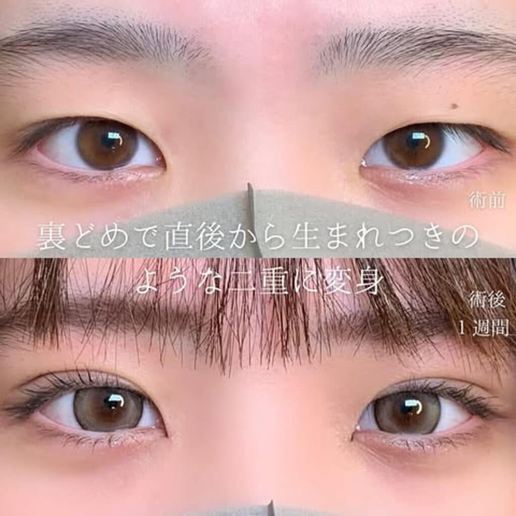 eclinic東京院の埋没法(裏留め)