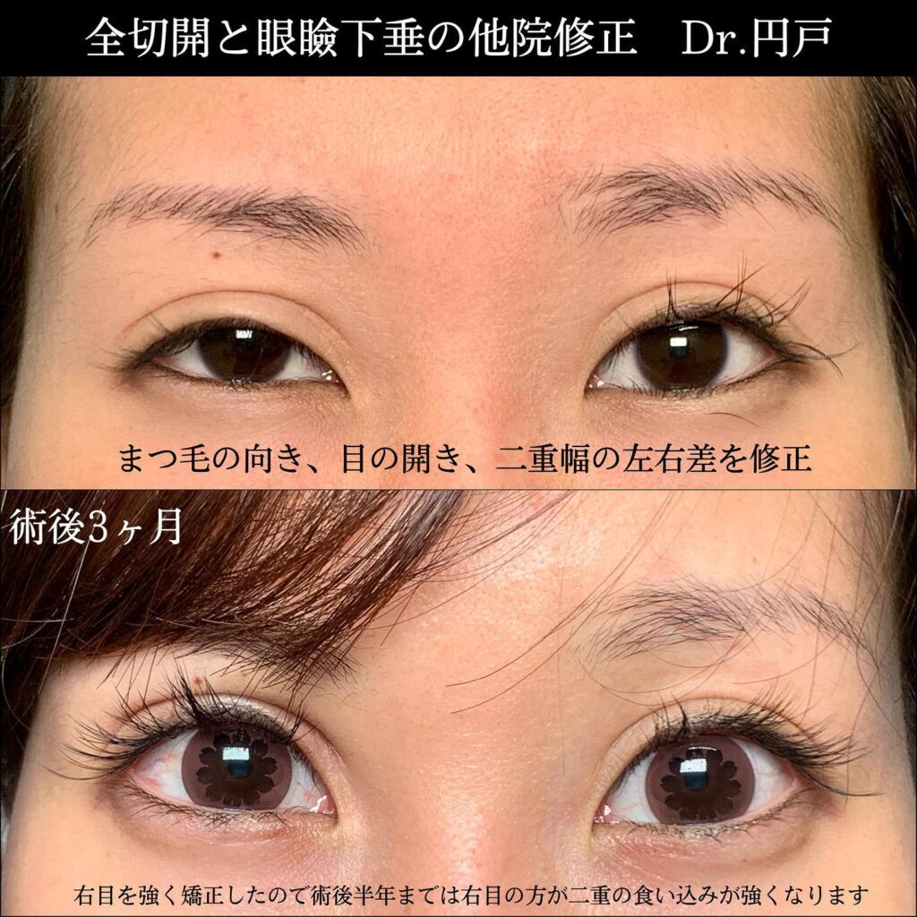 eclinic東京院の全切開二重術＋眼瞼下垂