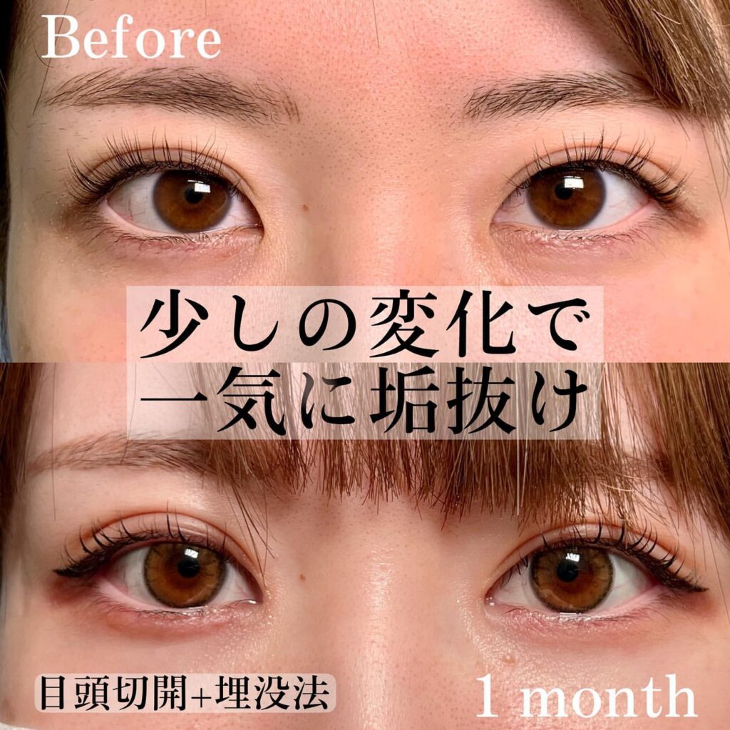 eclinic全切開二重術+目の上脱脂+他院埋没抜糸