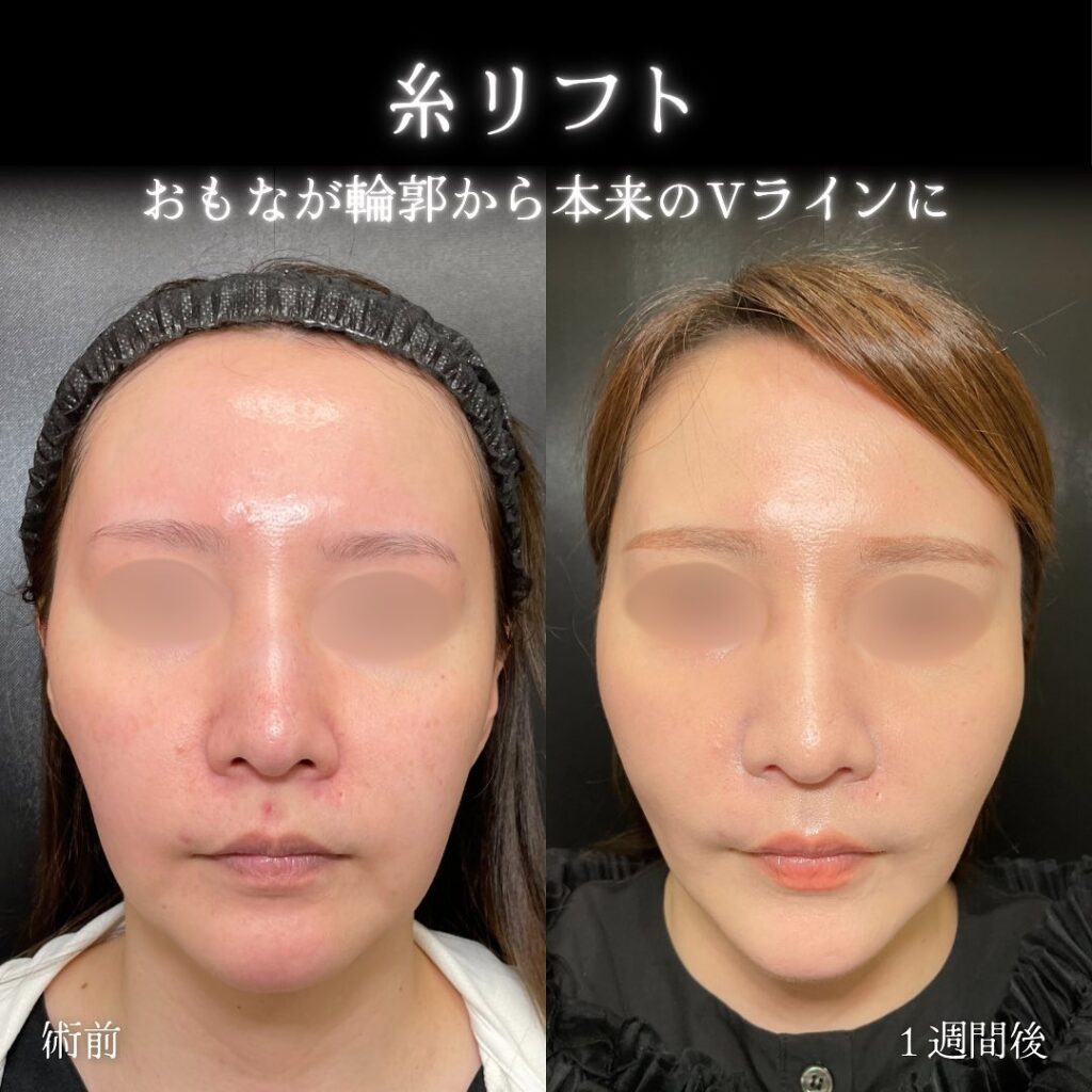 eクリニック東京院の糸リフトの症例写真 (6)