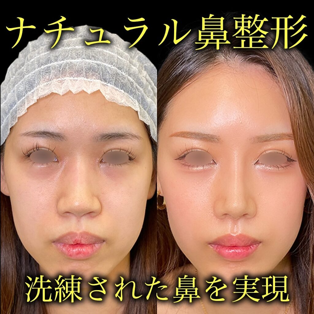 オープン法による鼻尖形成と 耳介軟骨移植と 小鼻縮小とプロテーゼと鼻柱下降の症例写真