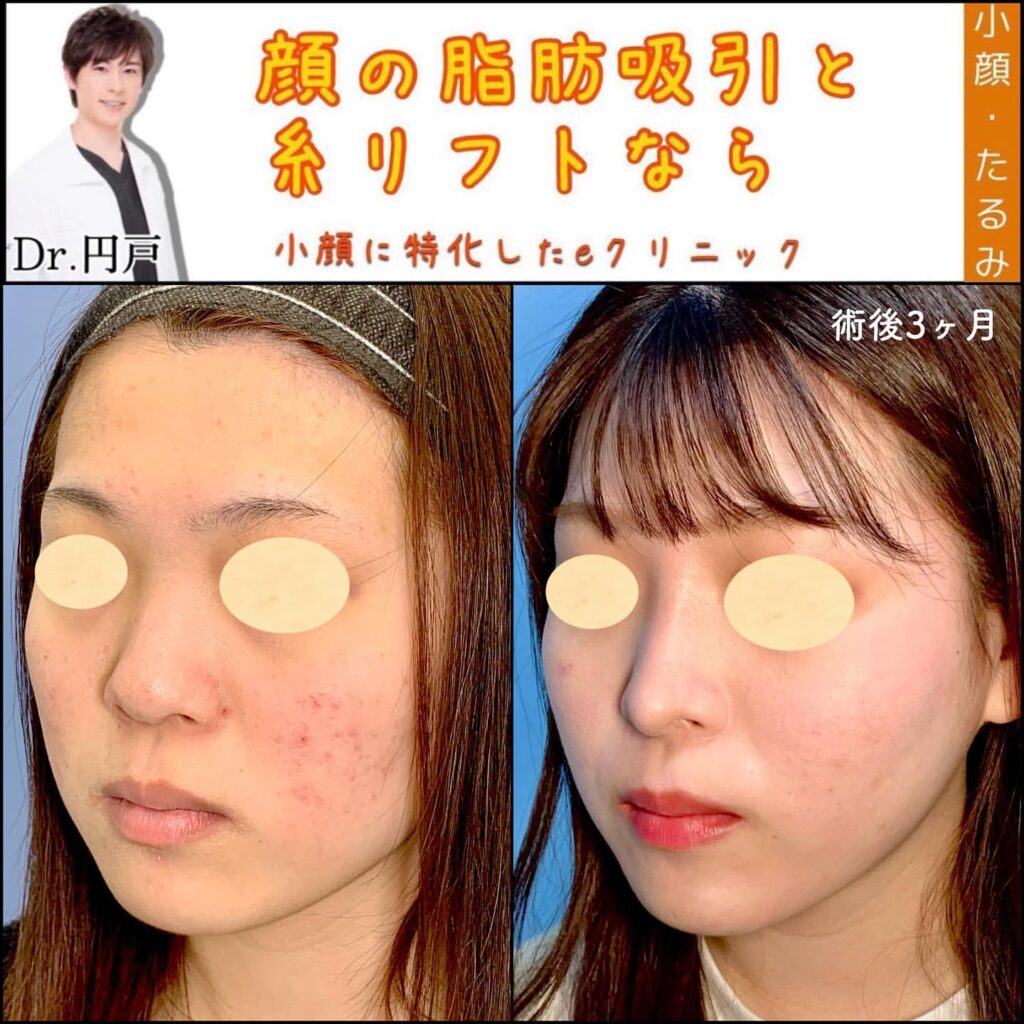 糸リフトの症例写真 (11)