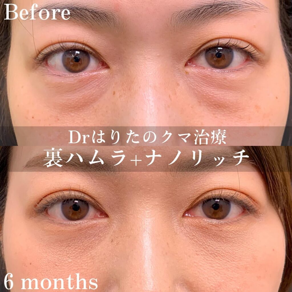 裏ハムラ法とナノリッチの症例写真