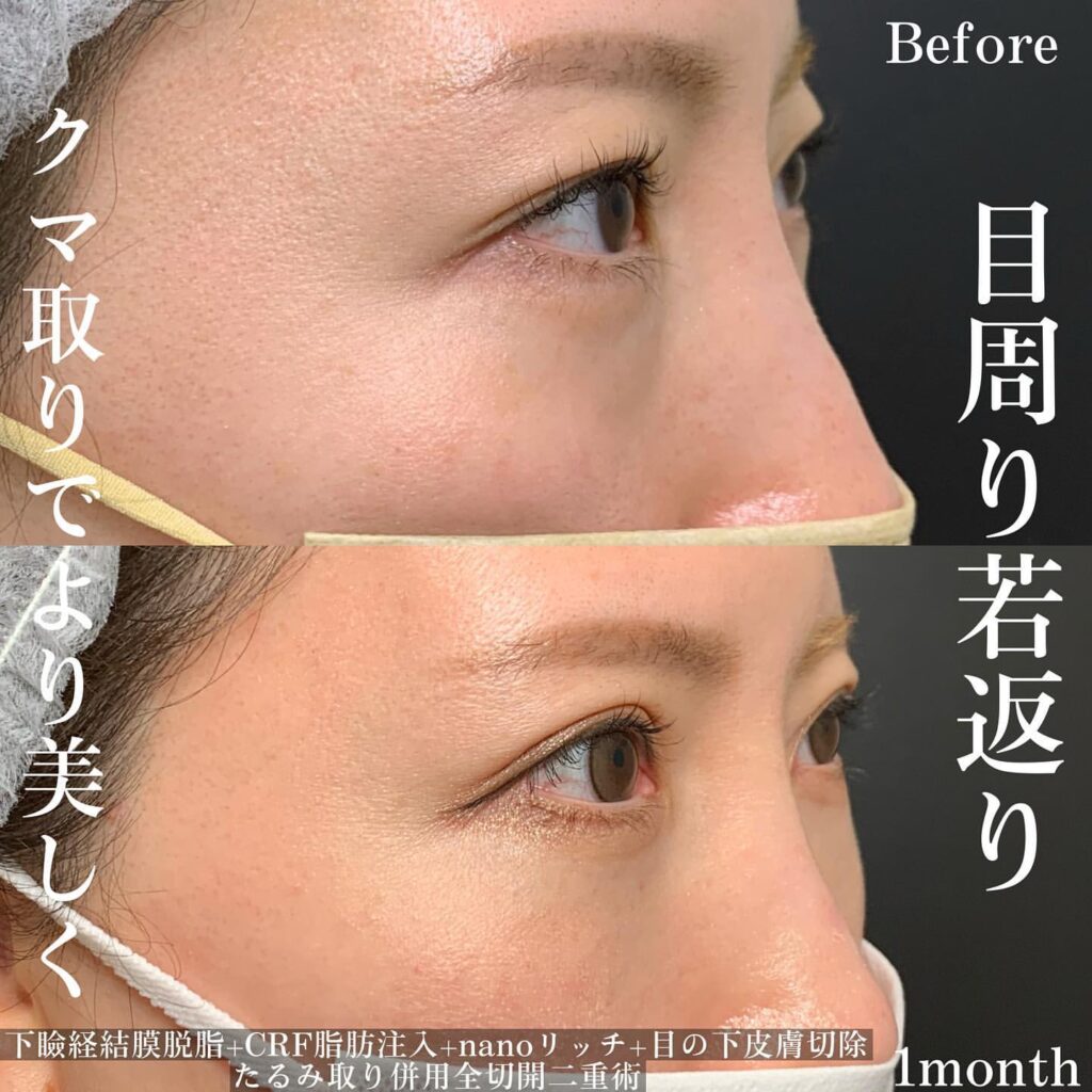eclinic東京院の目の上脱脂+脂肪注入ナノリッチ+皮膚切開+たるみ取り併用全切開