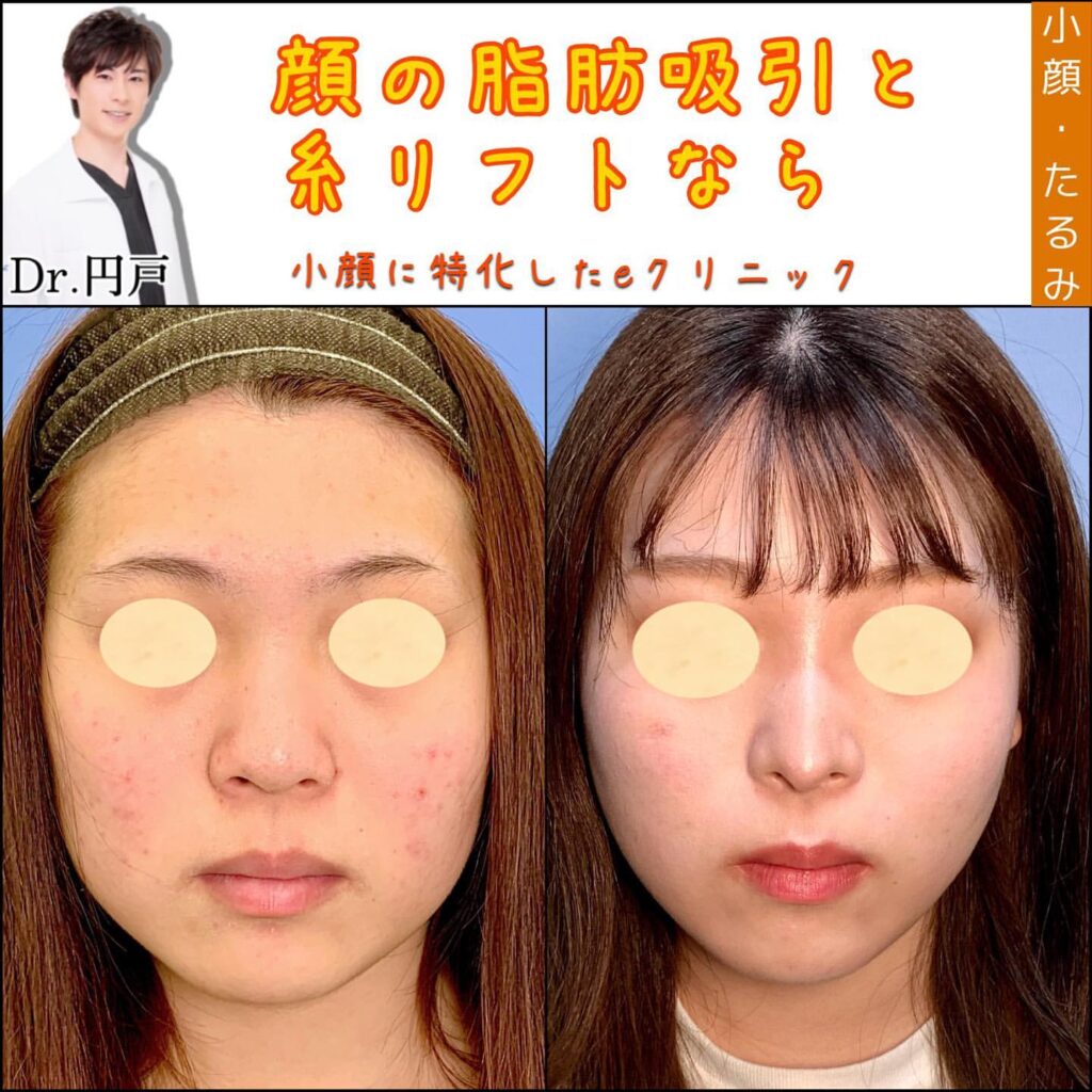 糸リフトの症例写真 (15)