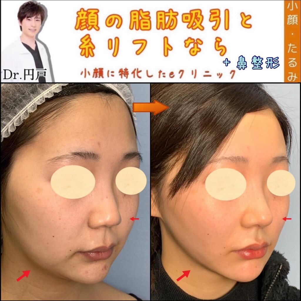 糸リフトの症例写真 (13)