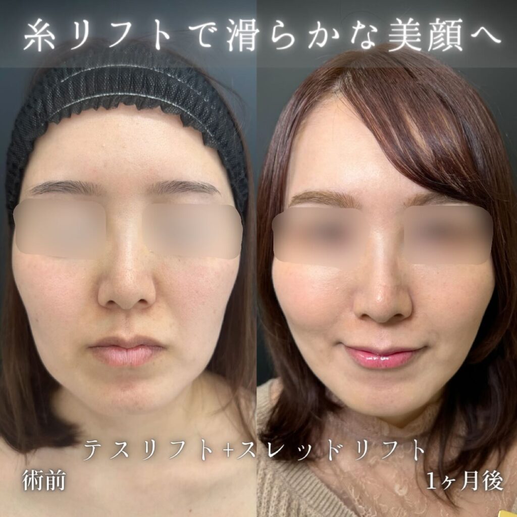 eクリニック東京院の糸リフトの症例写真