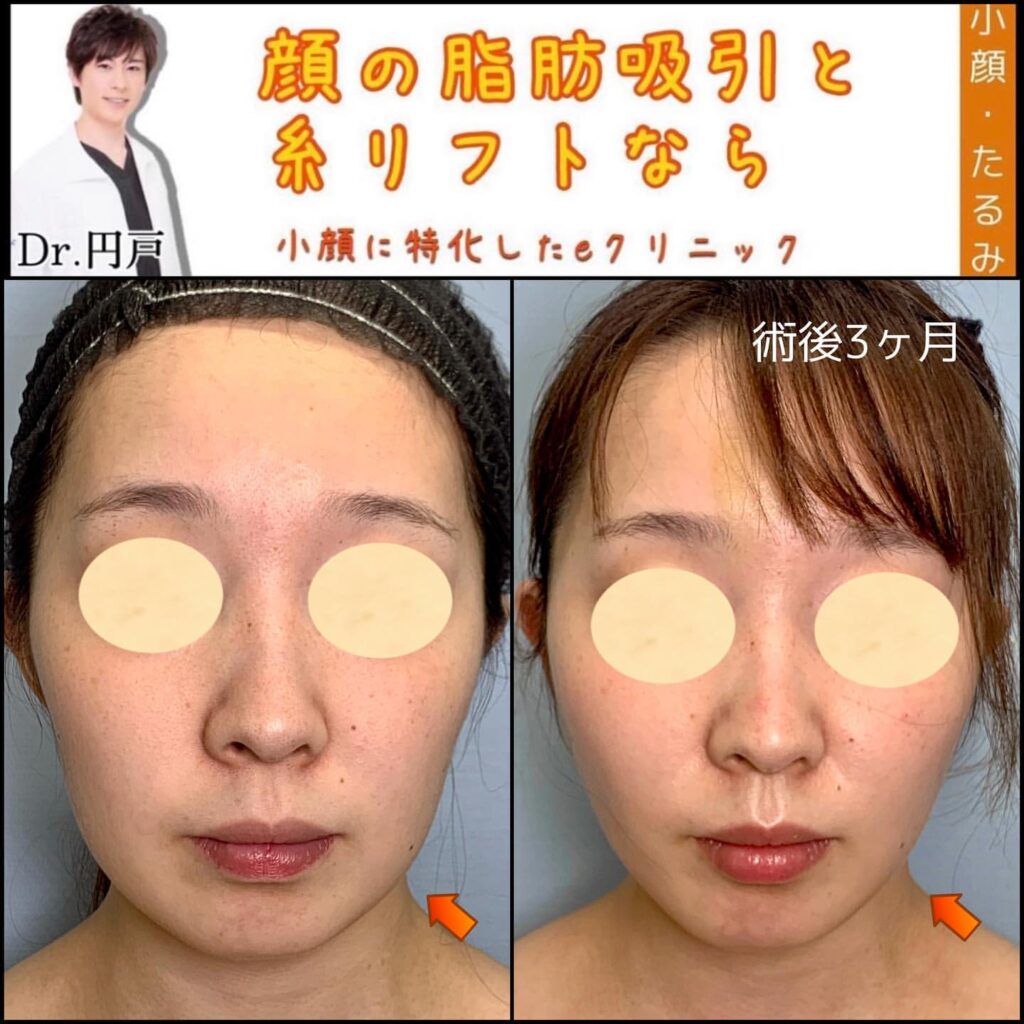 糸リフトの症例写真 (12)