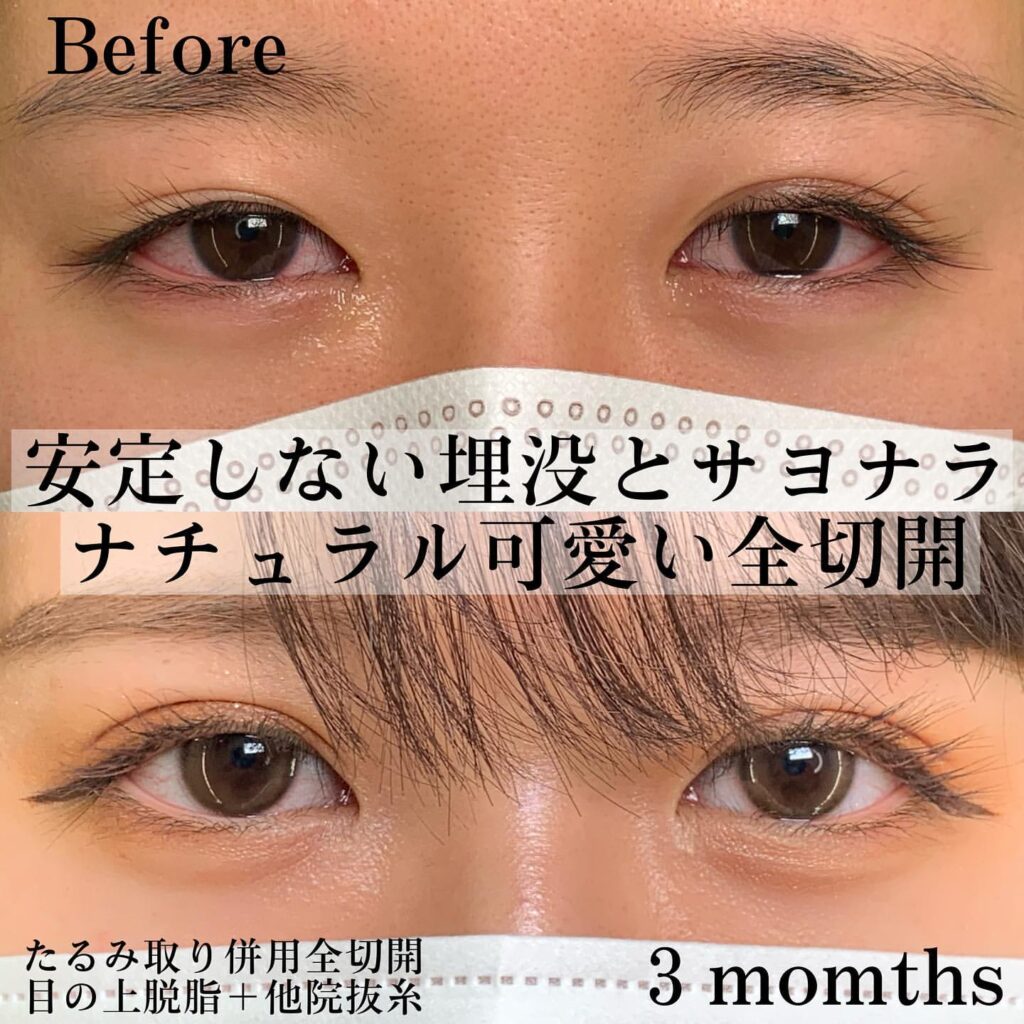 eclinic東京院のたるみ取り併用全切開＋目の上の脱脂＋他院の抜糸