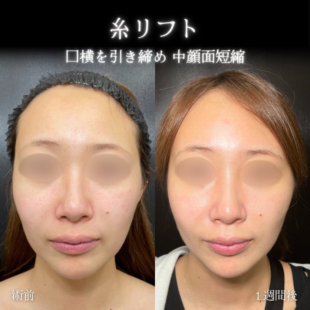 eクリニック東京院の糸リフトの症例写真(1)