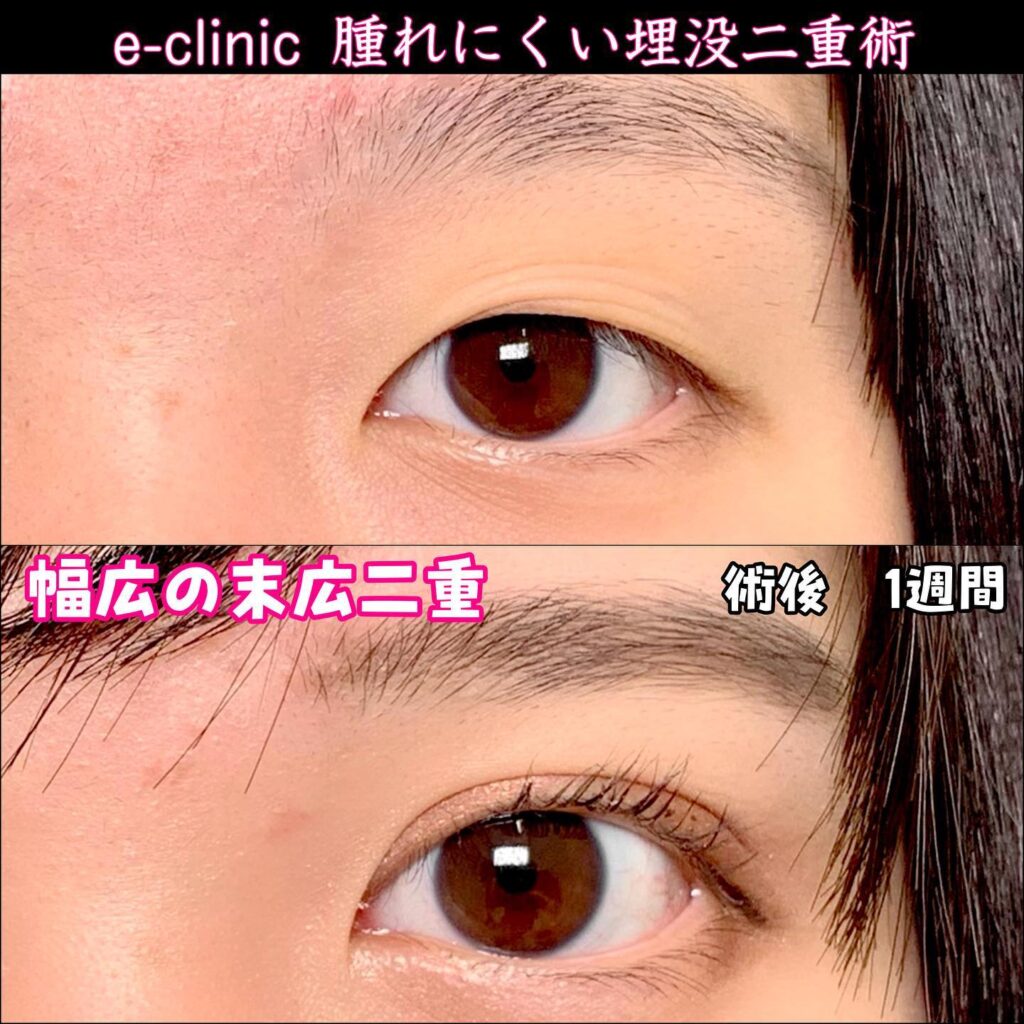 埋没法の症例写真 (8)