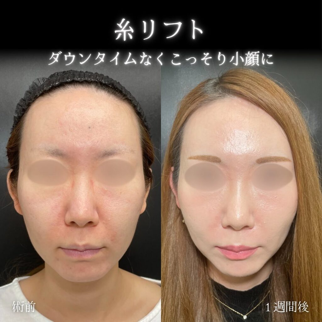 eクリニック東京院の糸リフトの症例写真 (5)