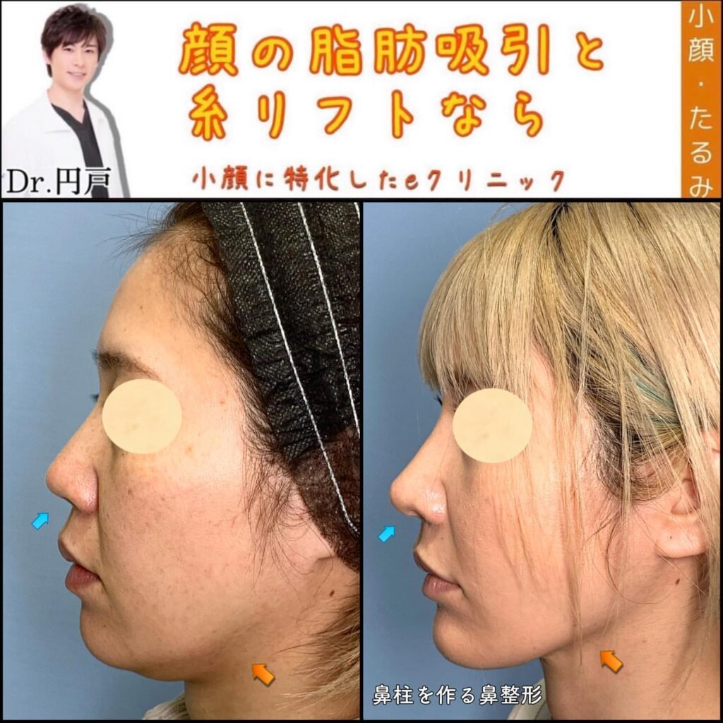 糸リフトの症例写真 (17)