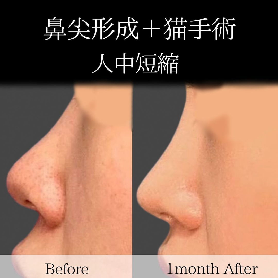 鼻尖形成と猫手術で人中短縮 | eクリニック東京院【公式】｜美容整形