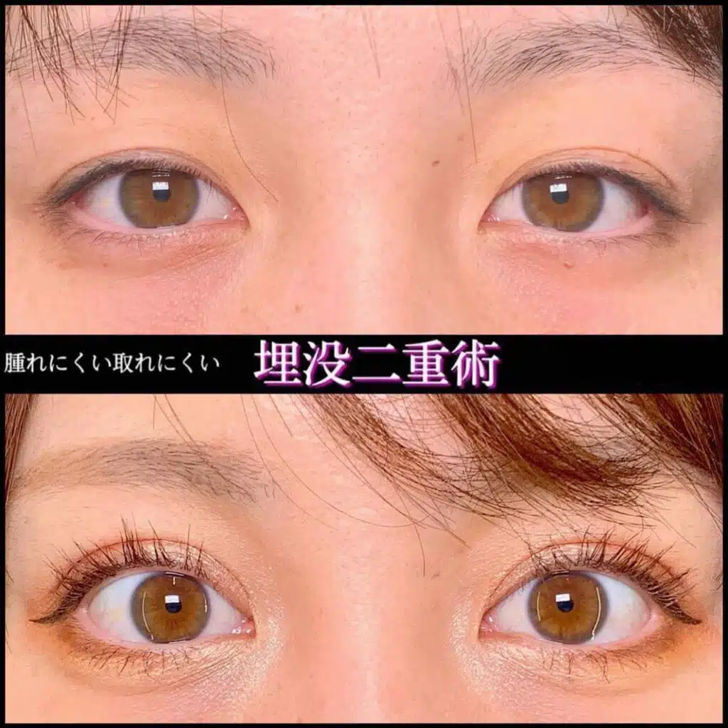 腫れにくい取れにくい 埋没二重術 東京