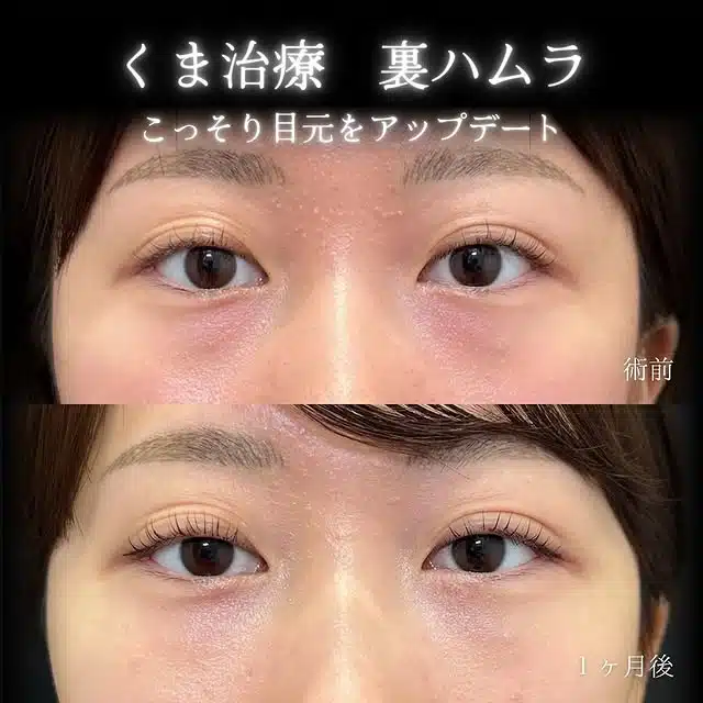 クマ取り 裏ハムラ法 東京