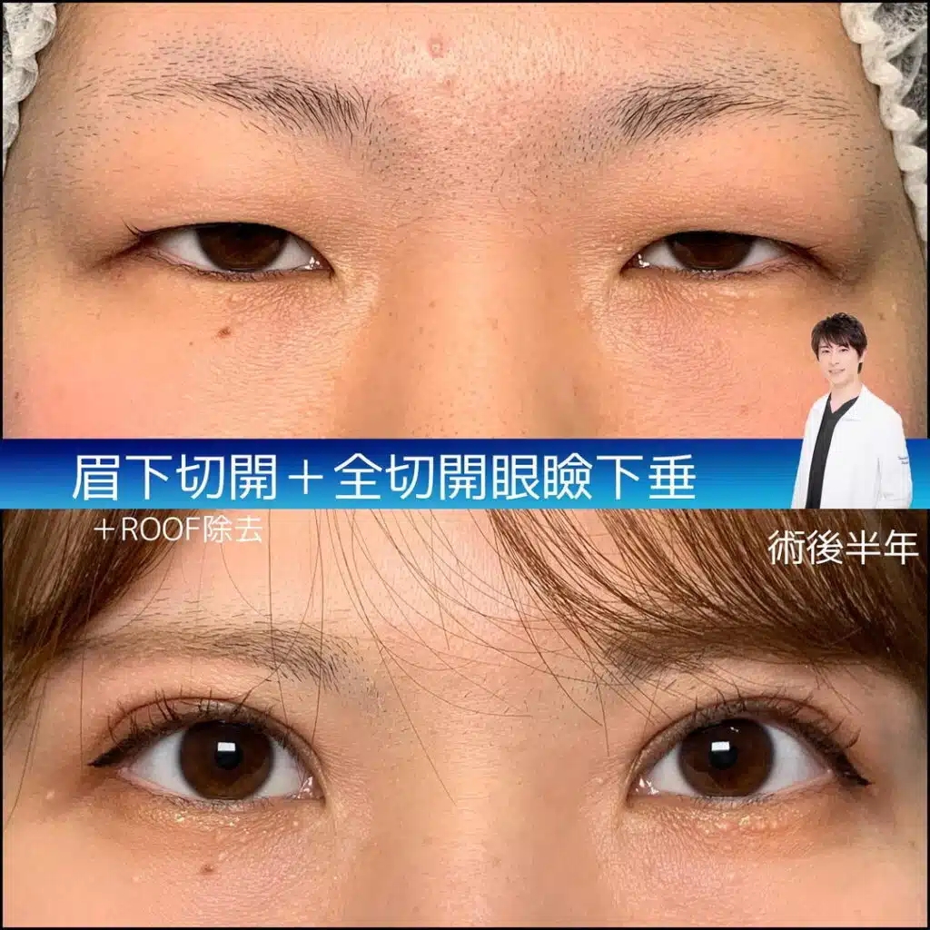 眉下切開 全切開眼瞼下垂 東京