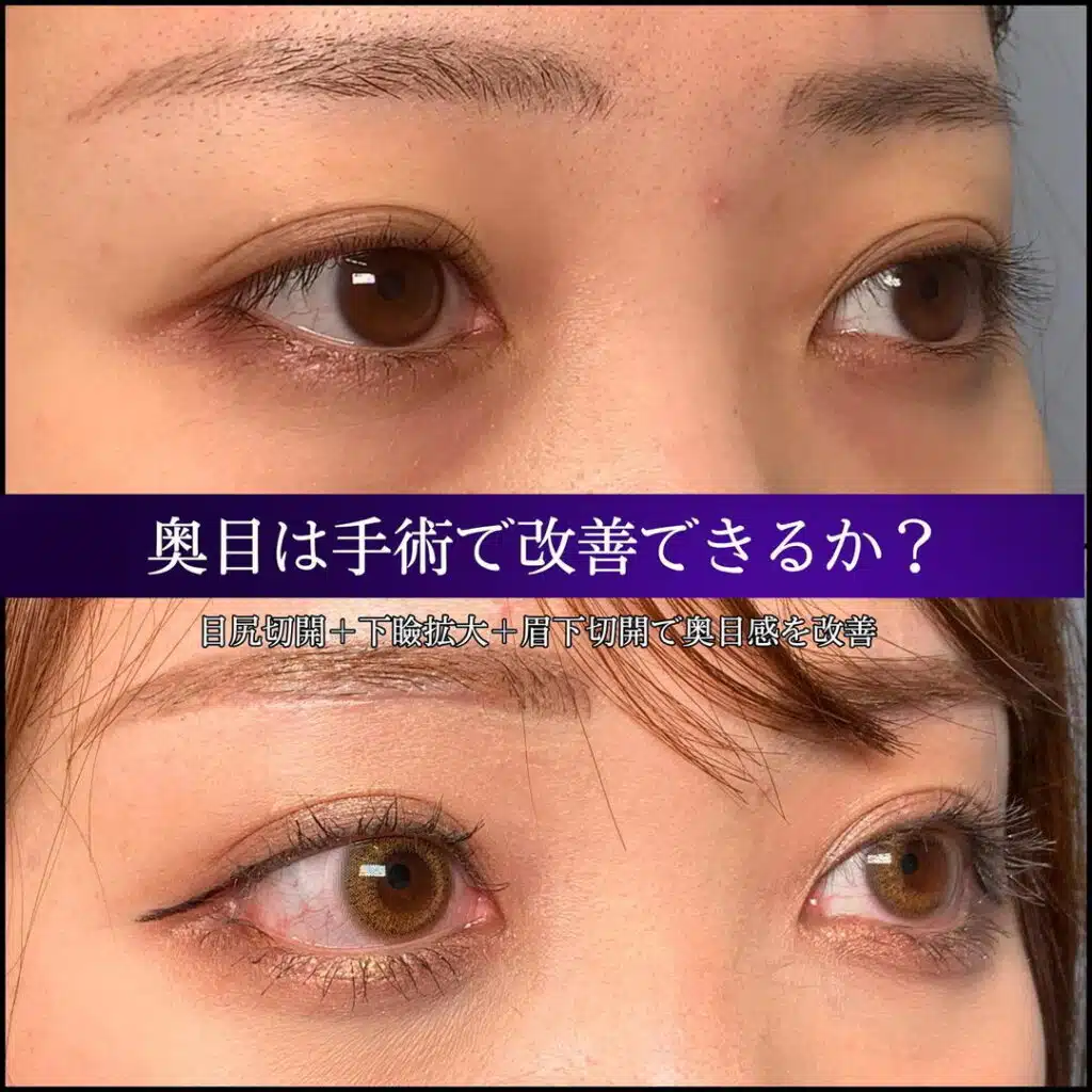 目尻切開 下瞼拡大 眉下切開 東京