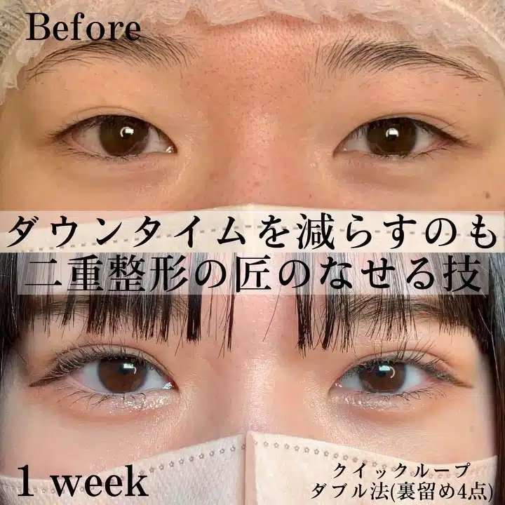 クイックループダブル法(裏留め4点) 東京