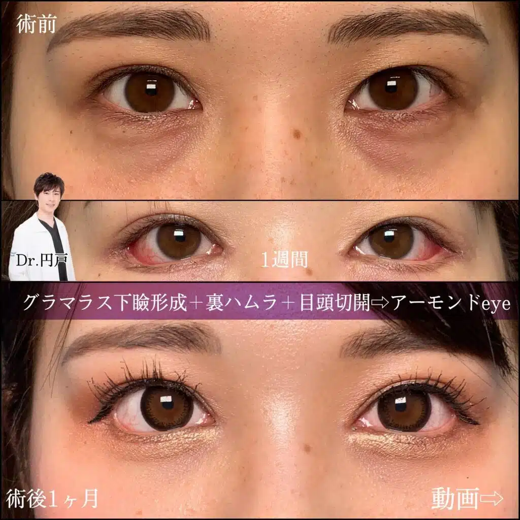 グラマラス下瞼形成 裏ハムラ 目頭切開 東京