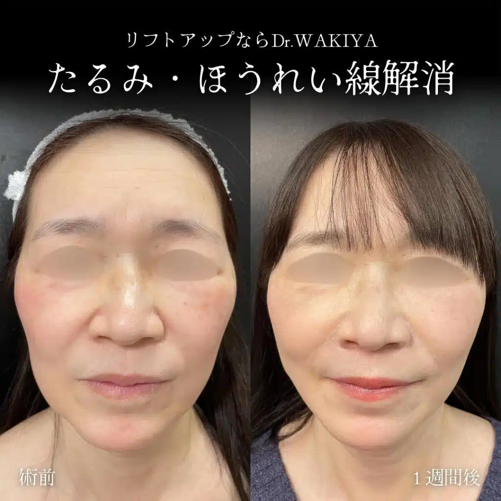 たるみ・ほうれい線解消 東京