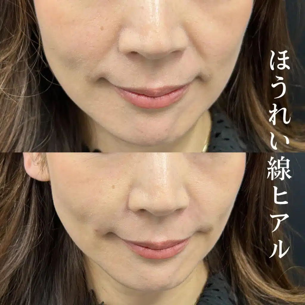 ほうれい線ヒアル 東京