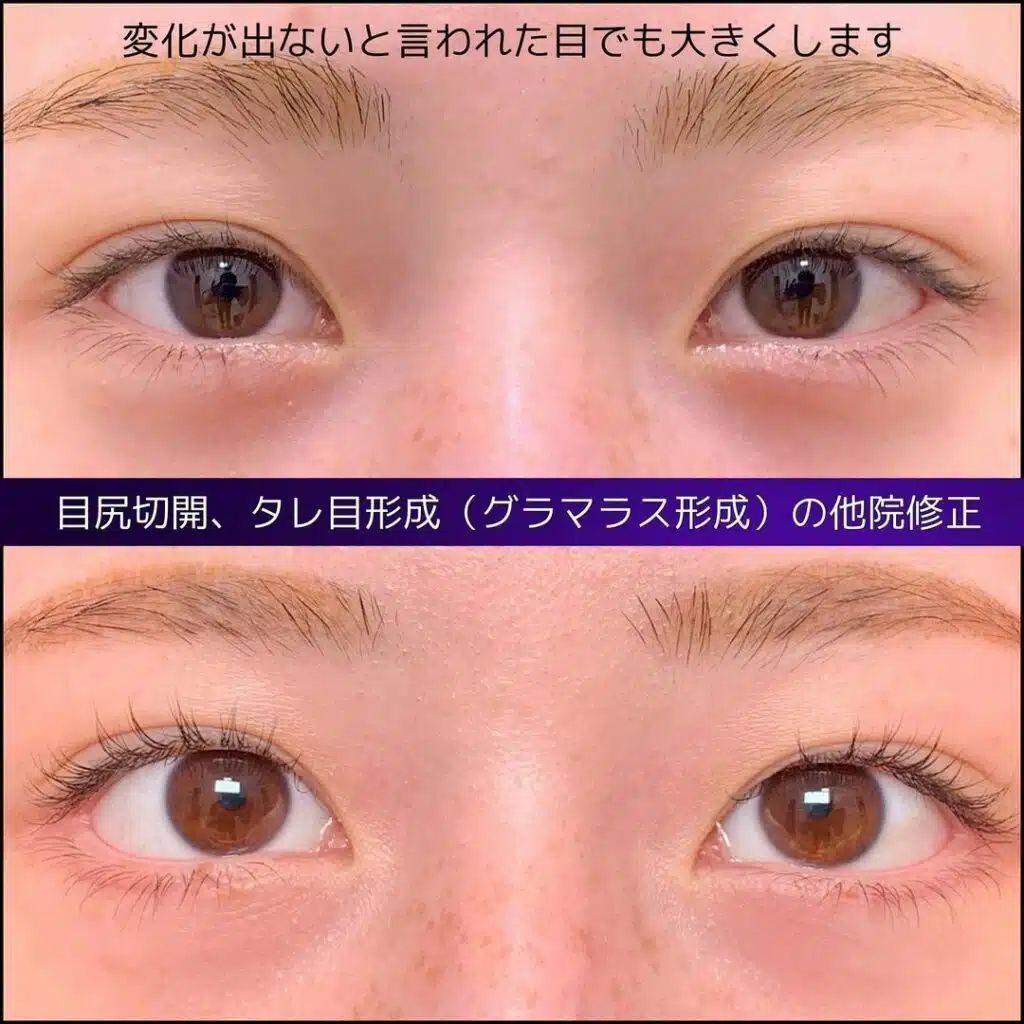 目尻切開 タレ目形成(グラマラス形成) 他院修正 東京