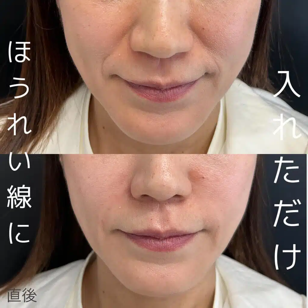 ほうれい線に入れただけ 東京