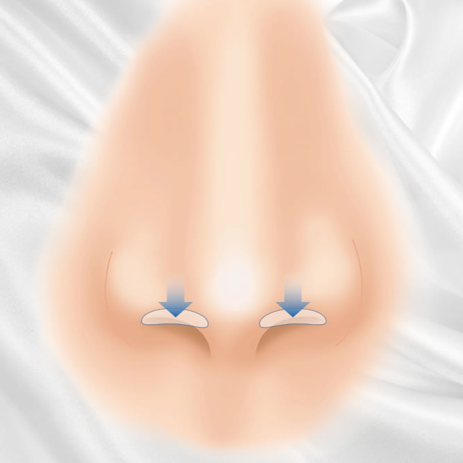 鼻孔縁下降のイメージ
